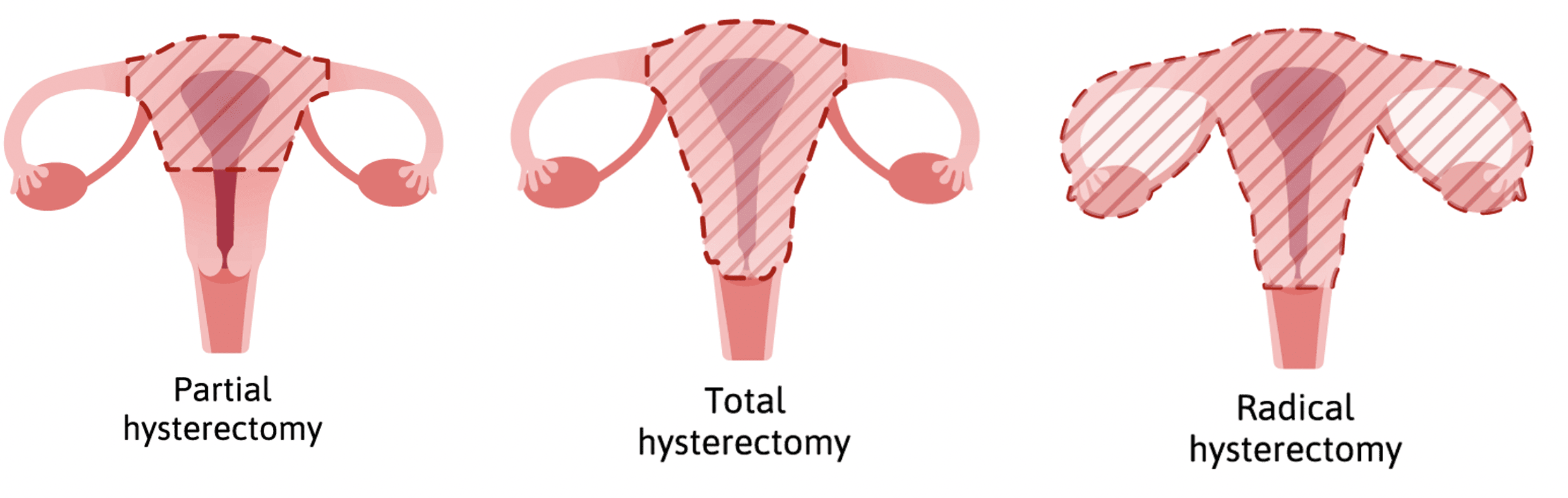 Hysterectomy a new lease on life   Maven Centre